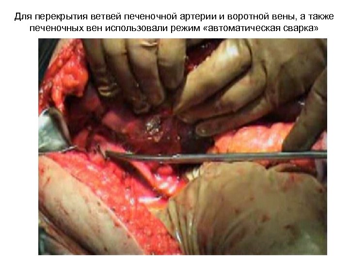 Для перекрытия ветвей печеночной артерии и воротной вены, а также печеночных вен использовали режим