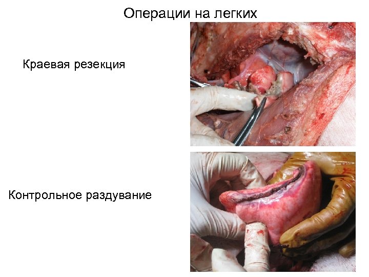 Операции на легких Краевая резекция Контрольное раздувание 