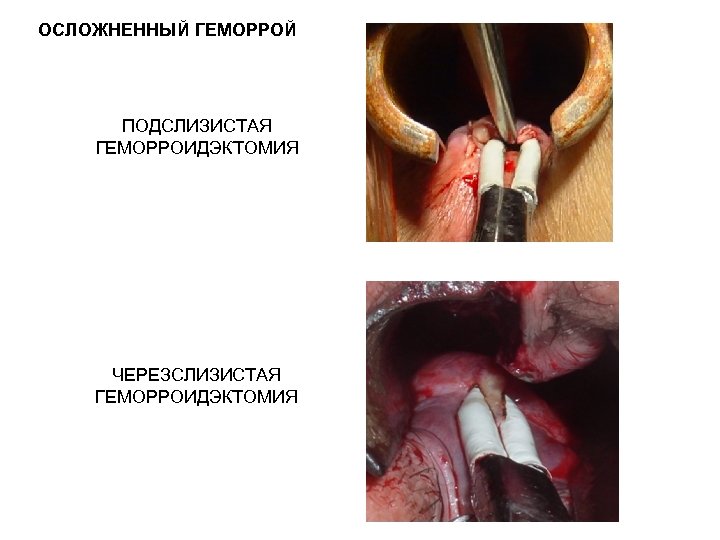 ОСЛОЖНЕННЫЙ ГЕМОРРОЙ ПОДСЛИЗИСТАЯ ГЕМОРРОИДЭКТОМИЯ ЧЕРЕЗСЛИЗИСТАЯ ГЕМОРРОИДЭКТОМИЯ 