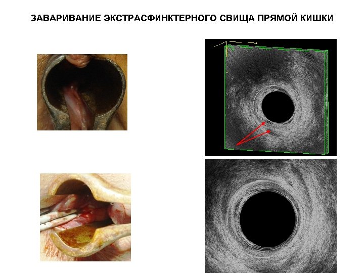 ЗАВАРИВАНИЕ ЭКСТРАСФИНКТЕРНОГО СВИЩА ПРЯМОЙ КИШКИ 