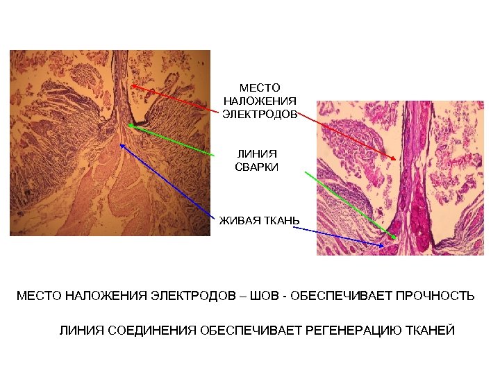 МЕСТО НАЛОЖЕНИЯ ЭЛЕКТРОДОВ ЛИНИЯ СВАРКИ ЖИВАЯ ТКАНЬ МЕСТО НАЛОЖЕНИЯ ЭЛЕКТРОДОВ – ШОВ - ОБЕСПЕЧИВАЕТ