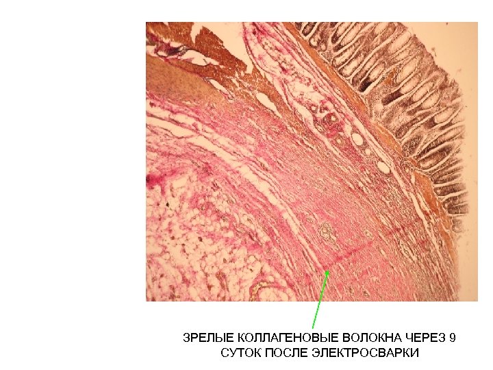 ЗРЕЛЫЕ КОЛЛАГЕНОВЫЕ ВОЛОКНА ЧЕРЕЗ 9 СУТОК ПОСЛЕ ЭЛЕКТРОСВАРКИ 