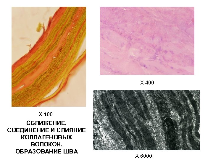 Х 400 Х 100 СБЛИЖЕНИЕ, СОЕДИНЕНИЕ И СЛИЯНИЕ КОЛЛАГЕНОВЫХ ВОЛОКОН, ОБРАЗОВАНИЕ ШВА X 6000