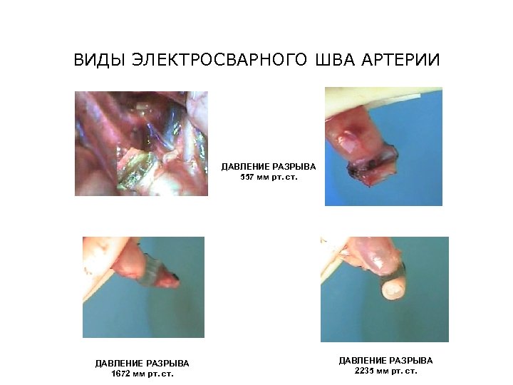 ВИДЫ ЭЛЕКТРОСВАРНОГО ШВА АРТЕРИИ ДАВЛЕНИЕ РАЗРЫВА 557 мм рт. ст. ДАВЛЕНИЕ РАЗРЫВА 1672 мм