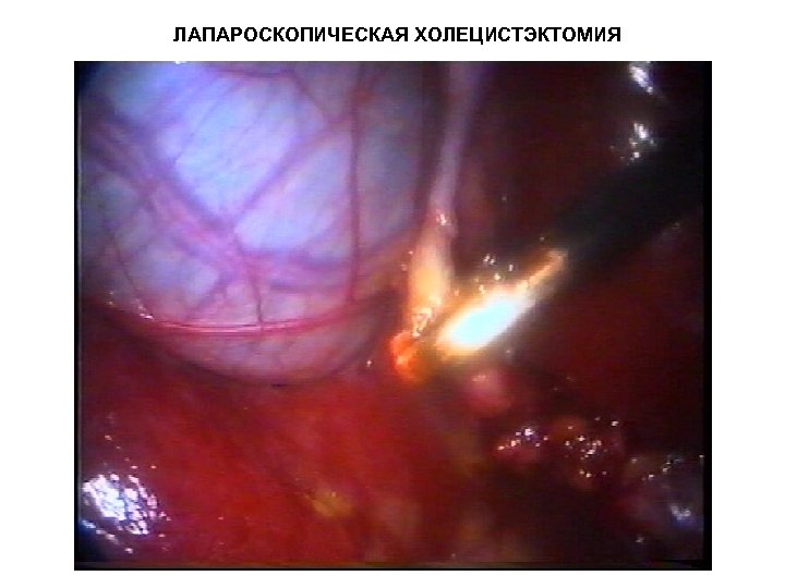 ЛАПАРОСКОПИЧЕСКАЯ ХОЛЕЦИСТЭКТОМИЯ 