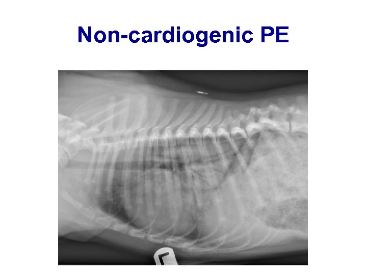 Non-cardiogenic PE 
