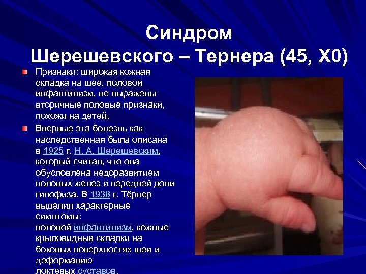 Синдром Шерешевского – Тернера (45, Х 0) Признаки: широкая кожная складка на шее, половой
