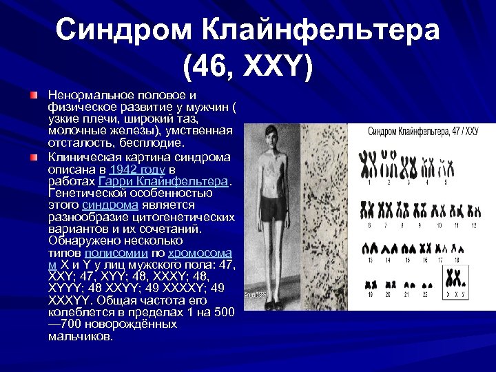 Синдром Клайнфельтера (46, ХХY) Ненормальное половое и физическое развитие у мужчин ( узкие плечи,