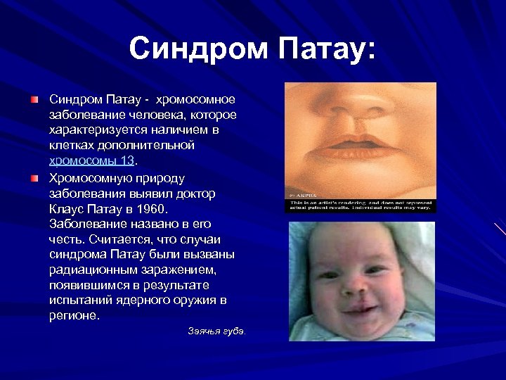 Синдром Патау: Синдром Патау - хромосомное заболевание человека, которое характеризуется наличием в клетках дополнительной