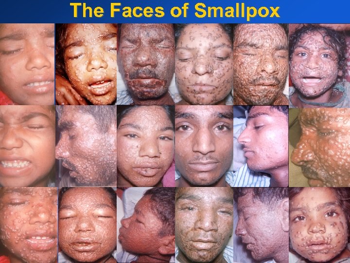 The Faces of Smallpox 