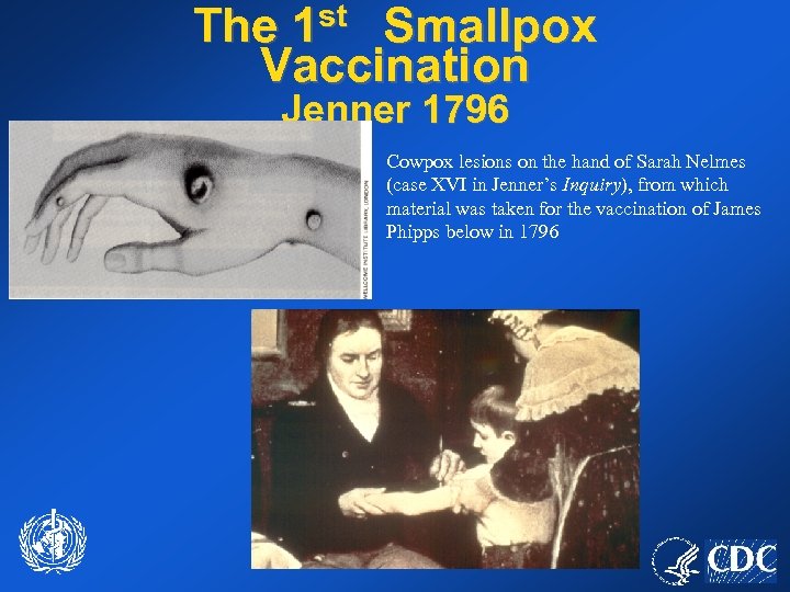 The 1 st Smallpox Vaccination Jenner 1796 Cowpox lesions on the hand of Sarah