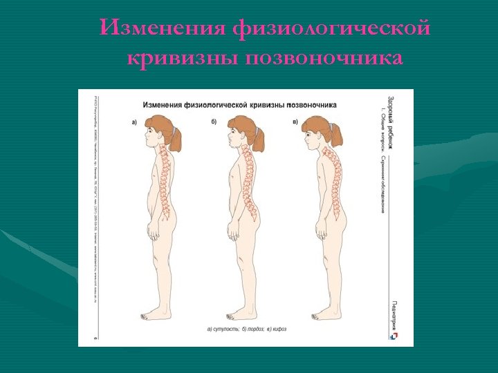 Изменения физиологической кривизны позвоночника 