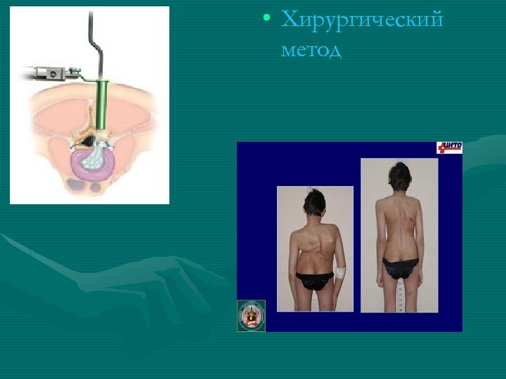  • Хирургический метод 