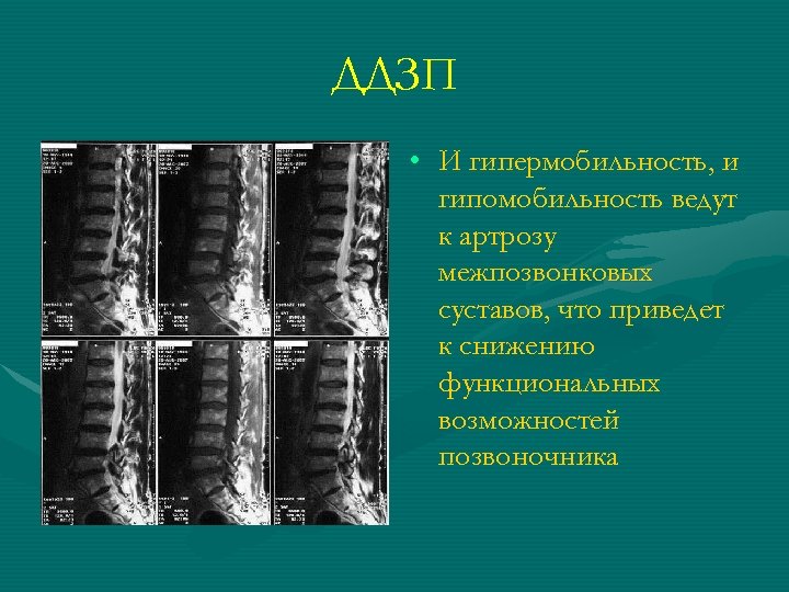 ДДЗП • И гипермобильность, и гипомобильность ведут к артрозу межпозвонковых суставов, что приведет к