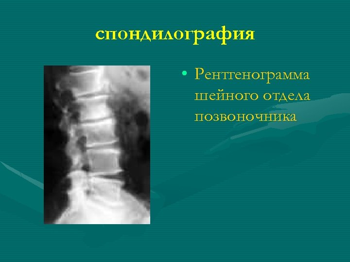 спондилография • Рентгенограмма шейного отдела позвоночника 