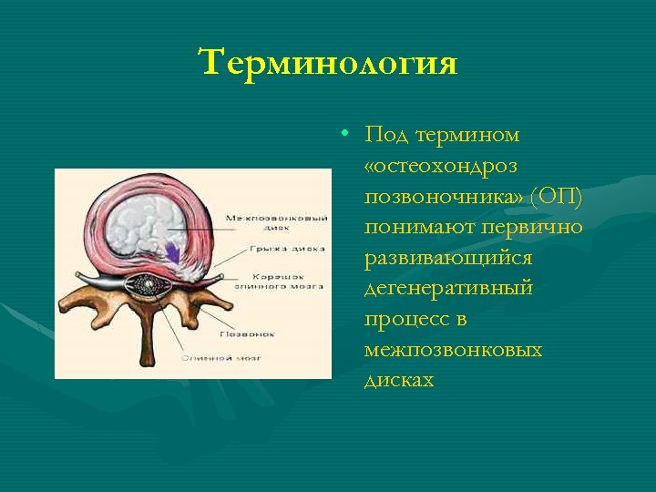 Терминология • Под термином «остеохондроз позвоночника» (ОП) понимают первично развивающийся дегенеративный процесс в межпозвонковых