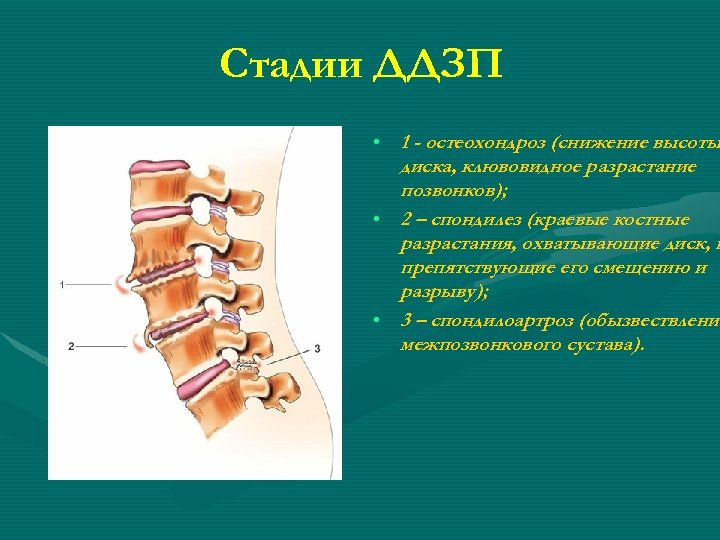 Стадии ДДЗП • 1 - остеохондроз (снижение высоты диска, клювовидное разрастание позвонков); • 2