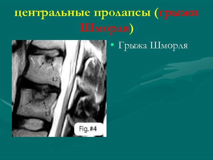 центральные пролапсы (грыжи Шморля) • Грыжа Шморля 