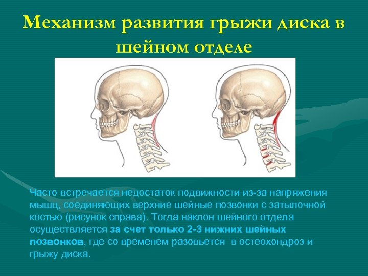 Механизм развития грыжи диска в шейном отделе Часто встречается недостаток подвижности из-за напряжения мышц,