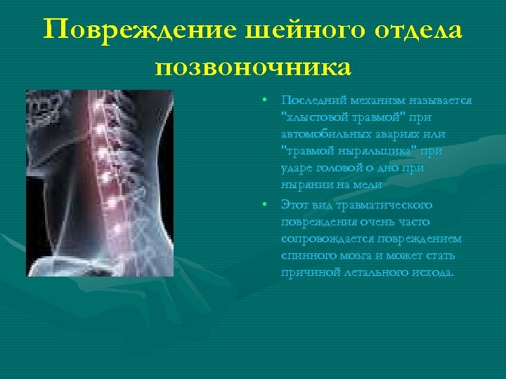 Повреждение шейного отдела позвоночника • Последний механизм называется "хлыстовой травмой" при автомобильных авариях или