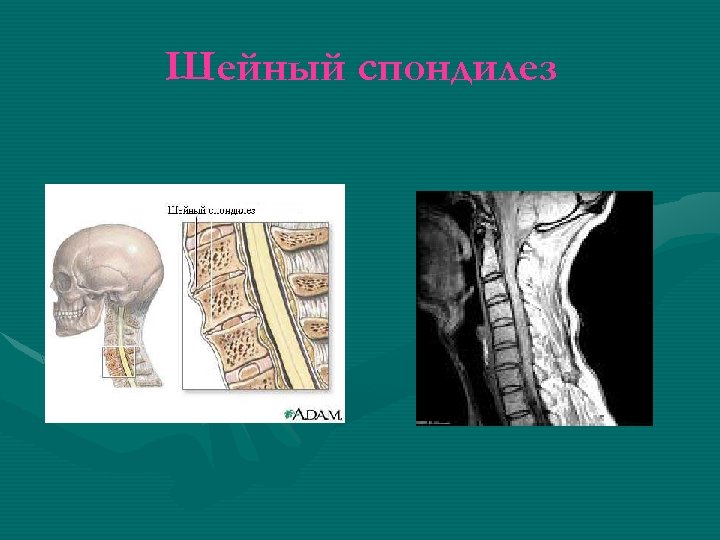 Шейный спондилез 