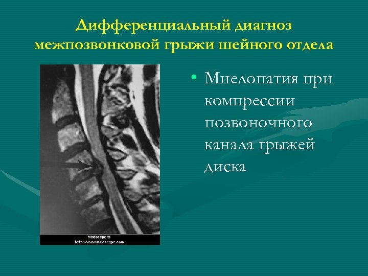 Дифференциальный диагноз межпозвонковой грыжи шейного отдела • Миелопатия при компрессии позвоночного канала грыжей диска