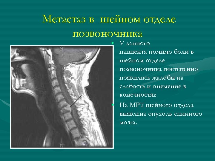  Метастаз в шейном отделе позвоночника • У данного пациента помимо боли в шейном