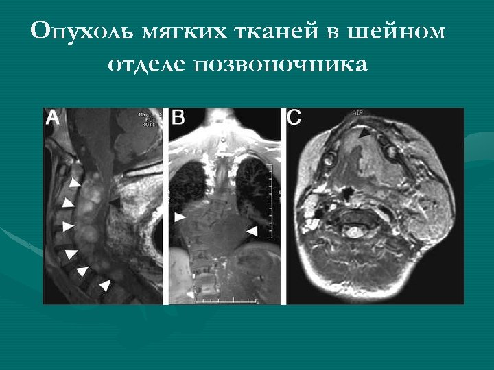 Опухоль мягких тканей в шейном отделе позвоночника 