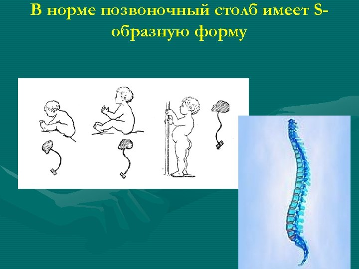 В норме позвоночный столб имеет Sобразную форму 