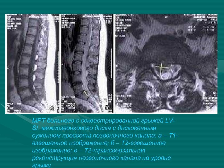 Грыжи диска МРТ больного с секвестрированной грыжей LVSI межпозвонкового диска с дискогенным сужением просвета