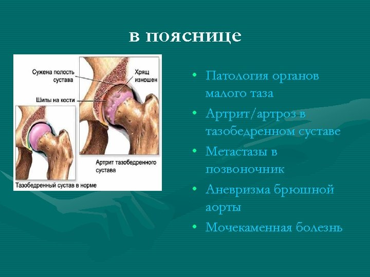 в пояснице • Патология органов малого таза • Артрит/артроз в тазобедренном суставе • Метастазы