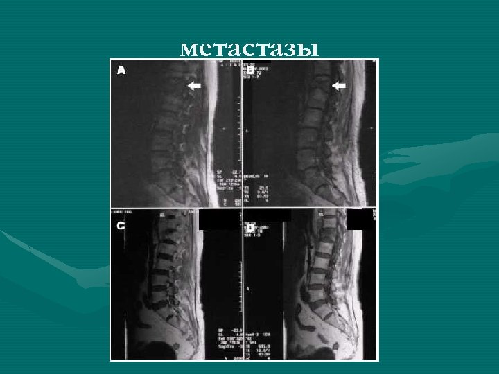 метастазы 
