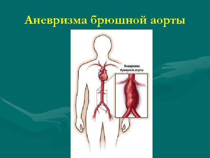 Аневризма брюшной аорты 