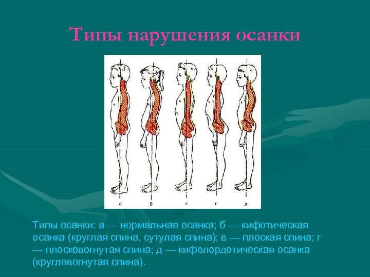 Типы нарушения осанки Типы осанки: а — нормальная осанка; б — кифотическая осанка (круглая