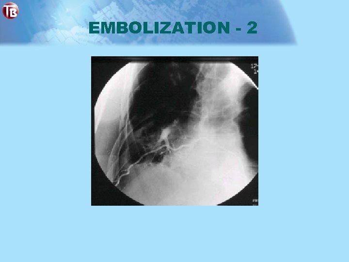 EMBOLIZATION - 2 