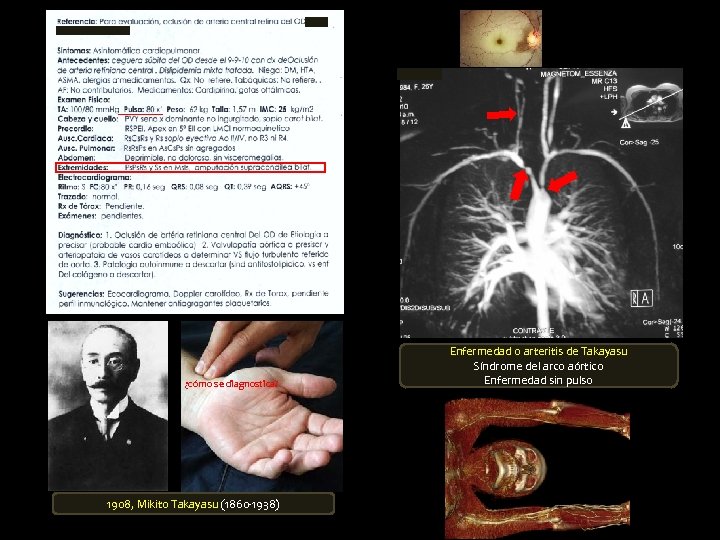¿cómo se diagnostica? 1908, Mikito Takayasu (1860 -1938) Enfermedad o arteritis de Takayasu Síndrome