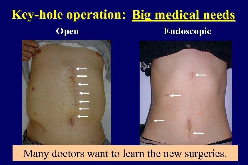 Key-hole operation: Big medical needs Open Endoscopic Many doctors want to learn the new