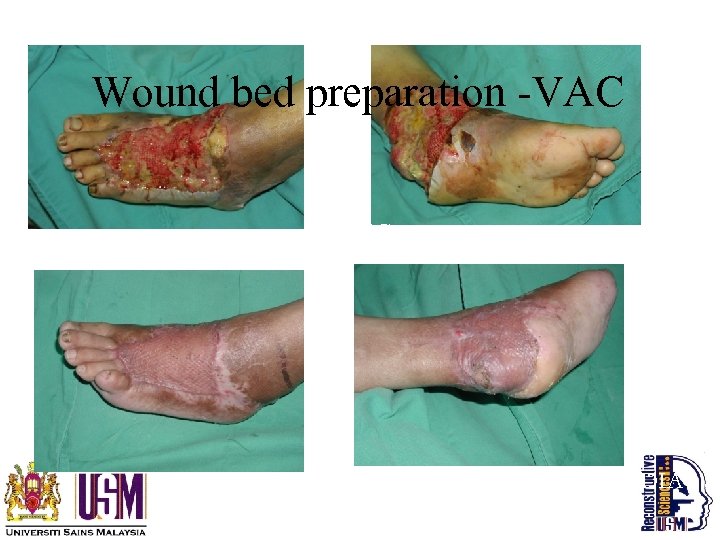 Wound bed preparation -VAC SSG TRAUMA IN DIABETIC PATIENT POOR CARDIAC ST 