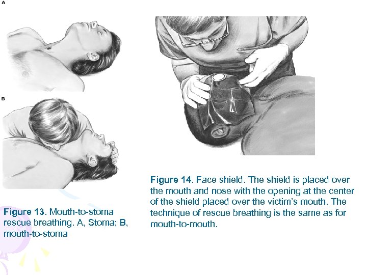 Figure 13. Mouth-to-stoma rescue breathing. A, Stoma; B, mouth-to-stoma Figure 14. Face shield. The