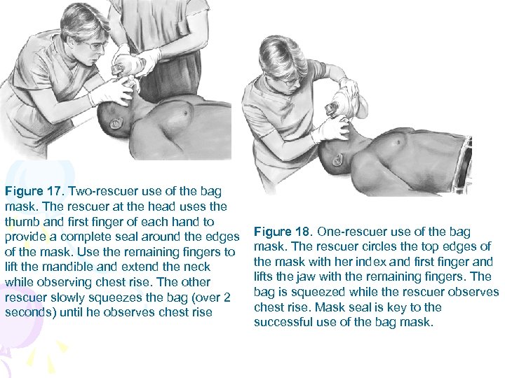 Figure 17. Two-rescuer use of the bag mask. The rescuer at the head uses
