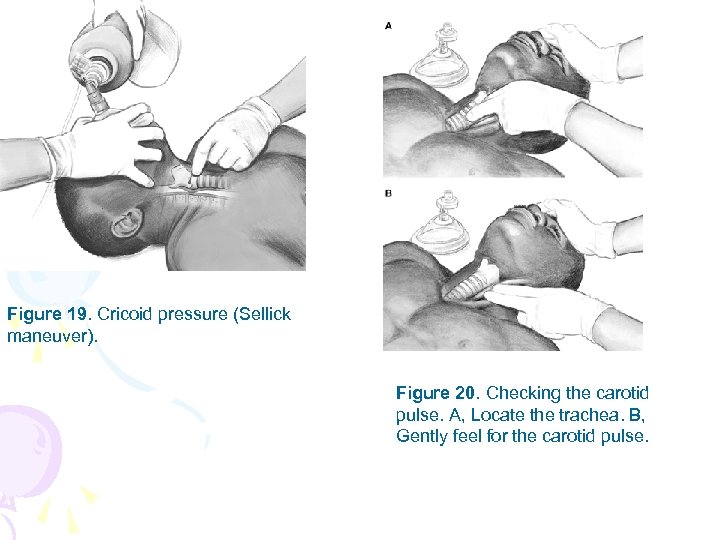 Figure 19. Cricoid pressure (Sellick maneuver). Figure 20. Checking the carotid pulse. A, Locate