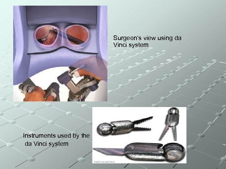 Surgeon’s view using da Vinci system Instruments used by the da Vinci system 