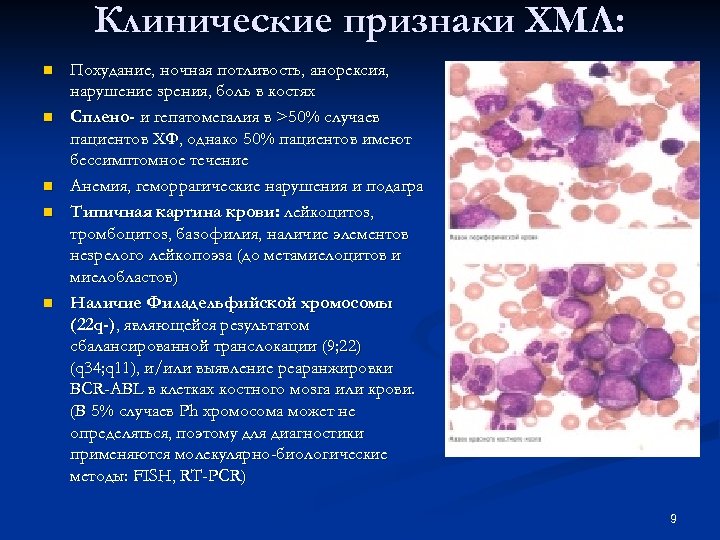 Клинические признаки ХМЛ: n n n Похудание, ночная потливость, анорексия, нарушение зрения, боль в