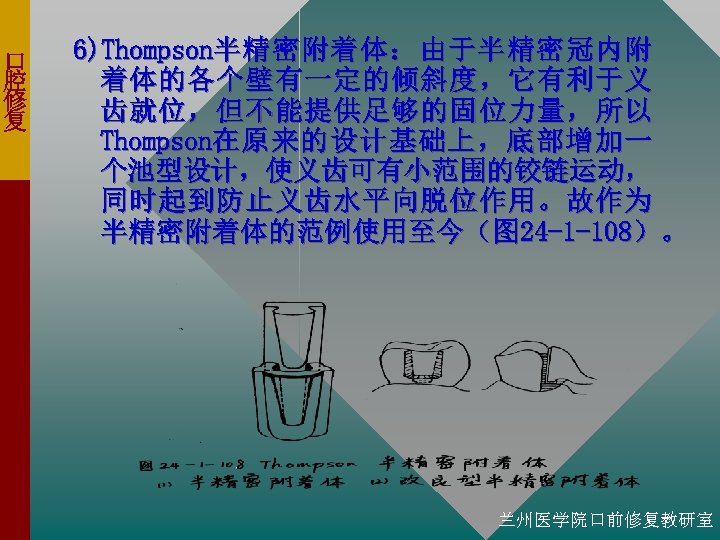 口 腔 修 复 6)Thompson半 精 密 附 着 体 ： 由 于 半