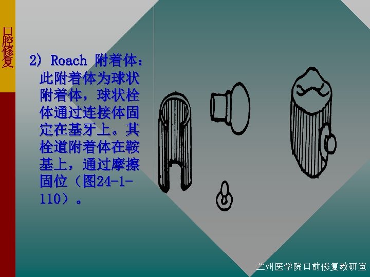 口 腔 修 复 2) Roach 附着体： 此附着体为球状 附着体，球状栓 体通过连接体固 定在基牙上。其 栓道附着体在鞍 基上，通过摩擦 固位（图