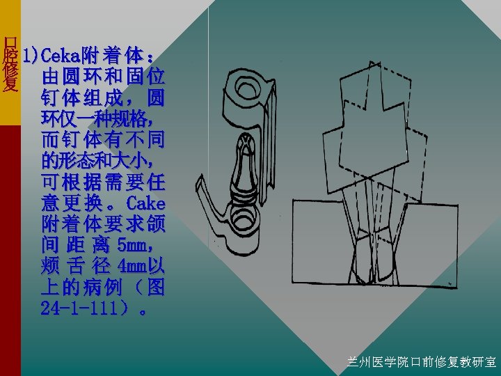 口 腔 1)Ceka附 着 体 ： 修 由圆环和固位 复 钉体组成，圆 环仅一种规格， 而钉体有不同 的形态和大小， 可根据需要任