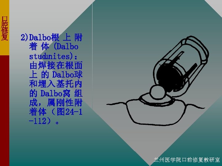 口 腔 修 复 2)Dalbo根 上 附 着 体 (Dalbo stud unites)： 由焊接在根面 上