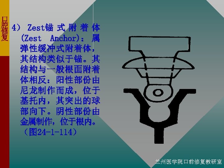口 腔 4） Zest锚 式 附 着 体 修 复 (Zest Anchor)： 属 弹性缓冲式附着体，