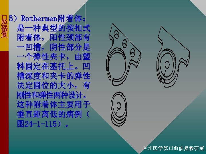 口 5） Rothermen附 着 体 ： 腔 修 是一种典型的按扣式 复 附着体，阳性颈部有 一凹槽，阴性部分是 一个弹性夹卡，由塑 料固定在基托上。凹