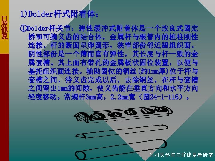 口 腔 修 复 1)Dolder杆式附着体： ①Dolder杆 关 节 ： 弹 性 缓 冲 式
